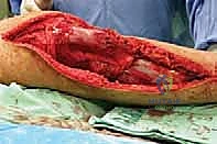 صورة طبية: استئصال الجزء القريب من عظم الساق (الظنبوب) وإعادة البناء بالطرف الصناعي: دليل شامل للمرضى