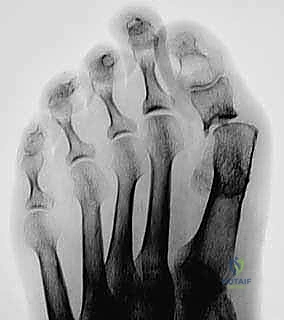 Revision First Metatarsophalangeal Joint Arthrodesis: An Intraoperative Masterclass