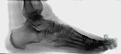 صورة شعاعية توضح التثبيت الدقيق لمفصل إبهام القدم الكبير المراجعة باستخدام الشرائح والمسامير الطبية