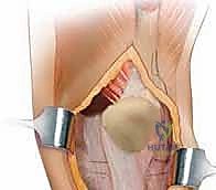 التحديات الجراحية في مراجعة مفصل الركبة