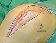 تحديد وقياس الشريحة العظمية TTO