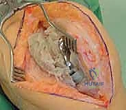 دواعي استعمال قطع الحدبة الظنبوبية