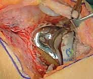 قطع الحدبة الظنبوبية في مراجعة استبدال مفصل الركبة الكلي: دليل شامل للمرضى مع الأستاذ الدكتور محمد هطيف