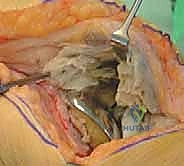 صورة توضيحية لـ قطع الحدبة الظنبوبية في مراجعة استبدال مفصل الركبة الكلي: دليل شامل للمرضى مع الأستاذ الدكتور محمد هطيف