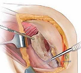إجراء القطع العظمي بالمنشار الجراحي