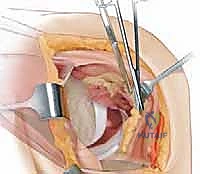 التعريض الواسع وإزالة المفصل القديم