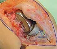 مقارنة بين التقنيات الجراحية للتعريض
