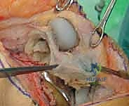 صورة توضيحية لـ قطع الحدبة الظنبوبية في مراجعة استبدال مفصل الركبة الكلي: دليل شامل للمرضى مع الأستاذ الدكتور محمد هطيف