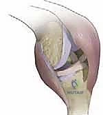 صورة توضيحية لـ قطع الحدبة الظنبوبية في مراجعة استبدال مفصل الركبة الكلي: دليل شامل للمرضى مع الأستاذ الدكتور محمد هطيف