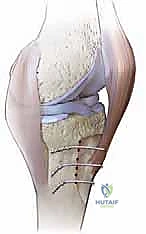 مراجعة استبدال مفصل الركبة الكلي مع الدكتور محمد هطيف