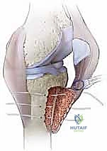 صورة توضيحية لـ قطع الحدبة الظنبوبية في مراجعة استبدال مفصل الركبة الكلي