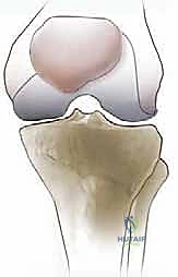 صورة توضيحية لـ قطع الحدبة الظنبوبية في مراجعة استبدال مفصل الركبة الكلي: دليل شامل للمرضى مع الأستاذ الدكتور محمد هطيف