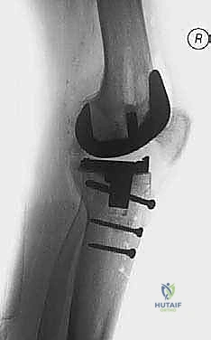 Extensile Exposure in Revision TKA: Mastering the Tibial Tubercle Osteotomy