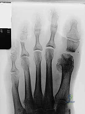 حالة سريرية توضح فشل جراحة سابقة وفقدان العظام