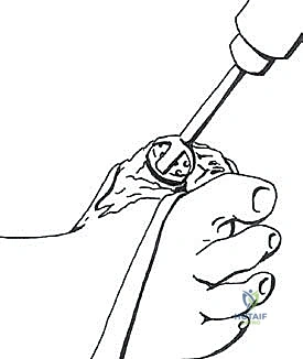 صورة توضح عدم قدرة الإصبع على ملامسة الأرض