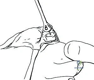 أشعة سينية للمتابعة في الأسبوع السادس