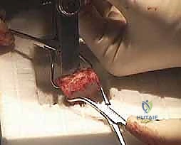 تطور الالتئام العظمي في الأشعة