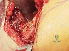 أشعة جانبية توضح استقامة المفصل