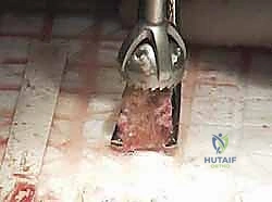 صورة توضيحية لـ اندماج مفصل إبهام القدم بتطعيم العظام: دليل شامل لاستعادة وظيفة القدم مع الأستاذ الدكتور محمد هطيف