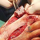 صورة توضيحية لـ اندماج مفصل إبهام القدم بتطعيم العظام: دليل شامل لاستعادة وظيفة القدم مع الأستاذ الدكتور محمد هطيف