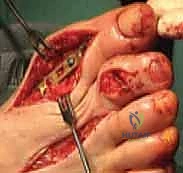 نحت وتشكيل الطعم العظمي ليلائم الفجوة