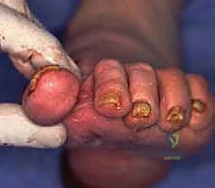 تنظيف الأنسجة الندبية وإزالة العظم الميت