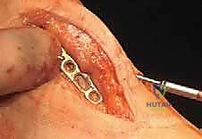 الكتلة العظمية المستخرجة قبل تشكيلها