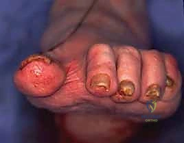 الشق الجراحي وكشف المفصل التالف