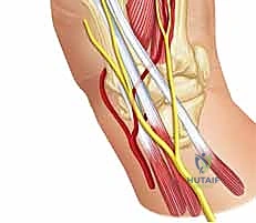 الصفيحة الراحية ومثبتات الإبهام