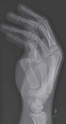 تقييم درجة الخلع بالأشعة