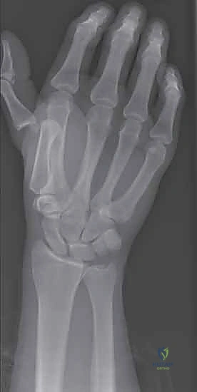 الأشعة السينية لخلع الإبهام