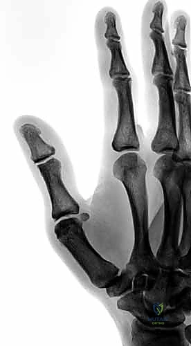 إبهام المتزلج وتمزق الأربطة