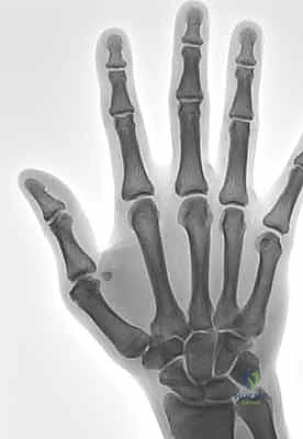 صورة توضيحية لـ عدم استقرار وخلع مفصل الإبهام السنعي السلامي: دليلك الشامل للعلاج الجراحي وغير الجراحي في صنعاء مع الأستاذ الدكتور محمد هطيف