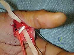 صورة رنين مغناطيسي توضح آفة ستينر