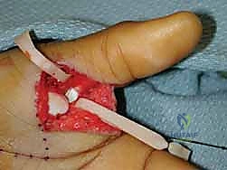 عدم استقرار وخلع مفصل الإبهام السنعي السلامي: دليلك الشامل للعلاج الجراحي وغير الجراحي في صنعاء مع الأستاذ الدكتور محمد هطيف