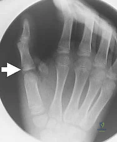 صورة توضيحية لـ عدم استقرار وخلع مفصل الإبهام السنعي السلامي: دليلك الشامل للعلاج الجراحي وغير الجراحي في صنعاء مع الأستاذ الدكتور محمد هطيف