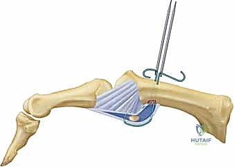 عدم القدرة على الإمساك بالأشياء