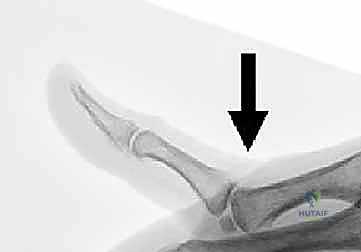 صورة طبية: عدم استقرار وخلع مفصل الإبهام السنعي السلامي: دليلك الشامل للعلاج الجراحي وغير الجراحي في صنعاء مع الأستاذ الدكتور محمد هطيف