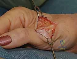 إصابة الإبهام الرياضية الشائعة