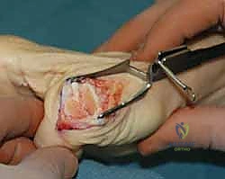 التخطيط الجراحي لإصلاح الأربطة