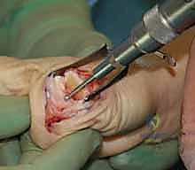 صورة طبية: عدم استقرار وخلع مفصل الإبهام السنعي السلامي: دليلك الشامل للعلاج الجراحي وغير الجراحي في صنعاء مع الأستاذ الدكتور محمد هطيف