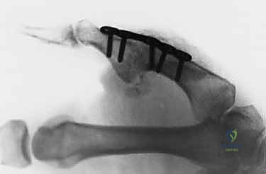 صورة طبية: عدم استقرار وخلع مفصل الإبهام السنعي السلامي: دليلك الشامل للعلاج الجراحي وغير الجراحي في صنعاء مع الأستاذ الدكتور محمد هطيف