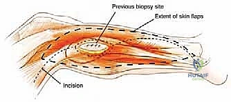 الشق الجراحي