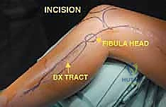 الوصول للورم