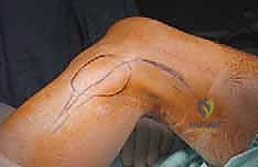 صورة طبية: استئصال الشظية: دليل شامل لمرضى أورام العظام وإنقاذ الأطراف مع الأستاذ الدكتور محمد هطيف في صنعاء