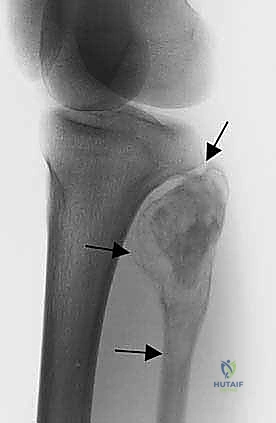 الاستئصال الجراحي