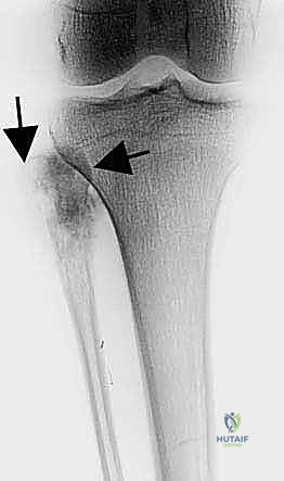 حماية العصب