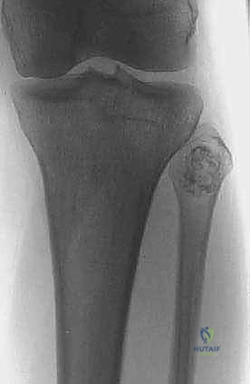 صورة طبية: استئصال الشظية: دليل شامل لمرضى أورام العظام وإنقاذ الأطراف مع الأستاذ الدكتور محمد هطيف في صنعاء