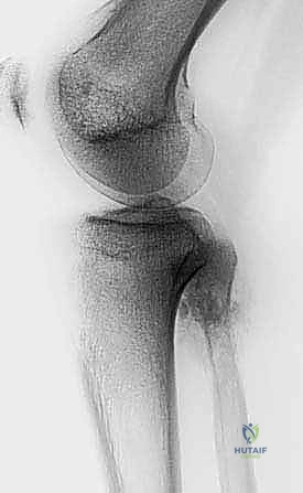 إعادة البناء