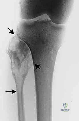 حماية العصب